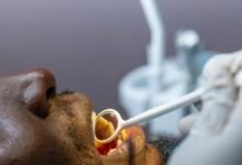 没公司牙科保险怎么办？dental discount plan 与牙科保险二选一全攻略-美国通