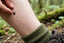 被蜱虫咬了怎么办:Lyme 病症状、10-14 天抗生素疗程与预防-美国通