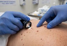 美国皮肤癌筛查 mole check:全身痣检查保险算 preventive 免费吗-美国通